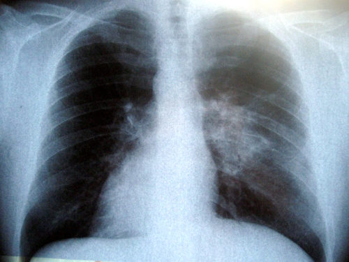 Zdjęcie rentgenowskie klatki piersiowej.